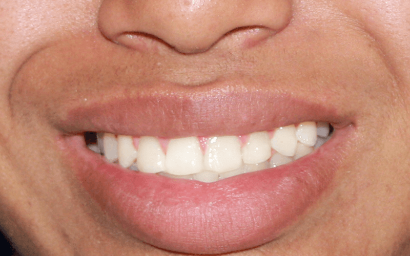 Patient Smile After Orthodontic treatment in Montebello Nueva Smile