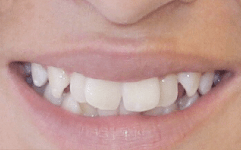 Smile Before Orthodontic treatment in Montebello Nueva Smile