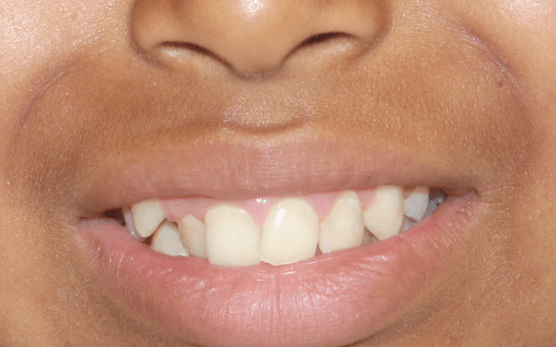Patient Smile Before Orthodontic treatment in Montebello Nueva Smile