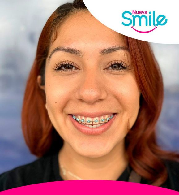 Braces in Montebello Nueva Smile - Patient Smiling