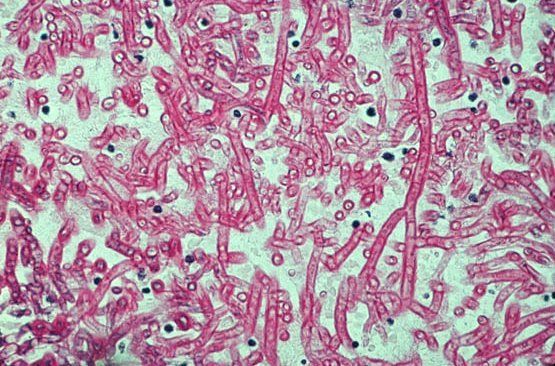 Gliotoxin has been found in aspergillosis
