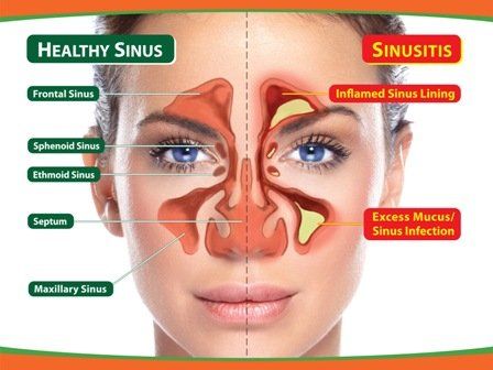 Global Indoor Health Network - Chronic Sinusitis