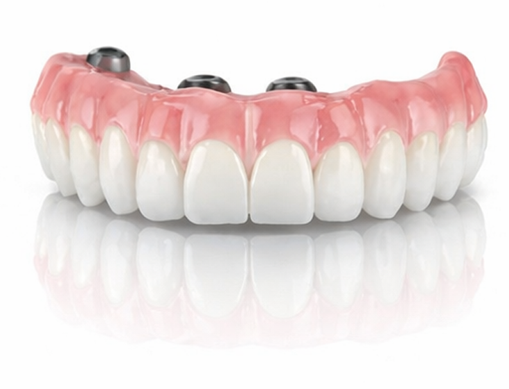Full arch dental implants with prosthetic teeth