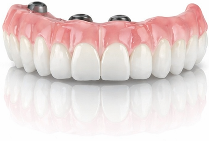 Full arch dental implants prosthetic with gum base