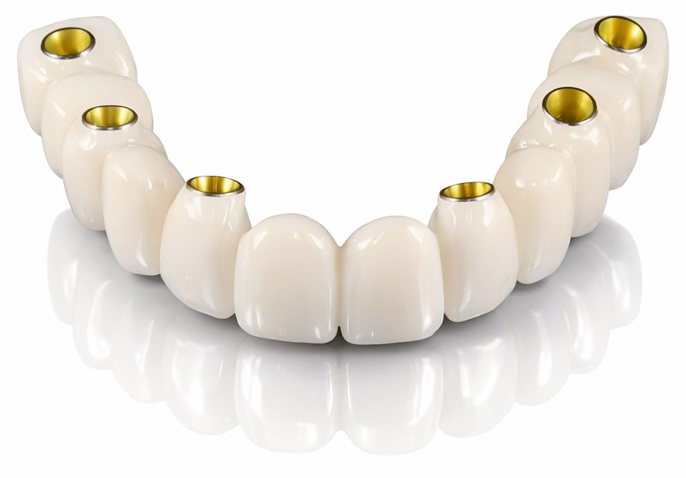 Full arch dental implant bridge with screw access holes