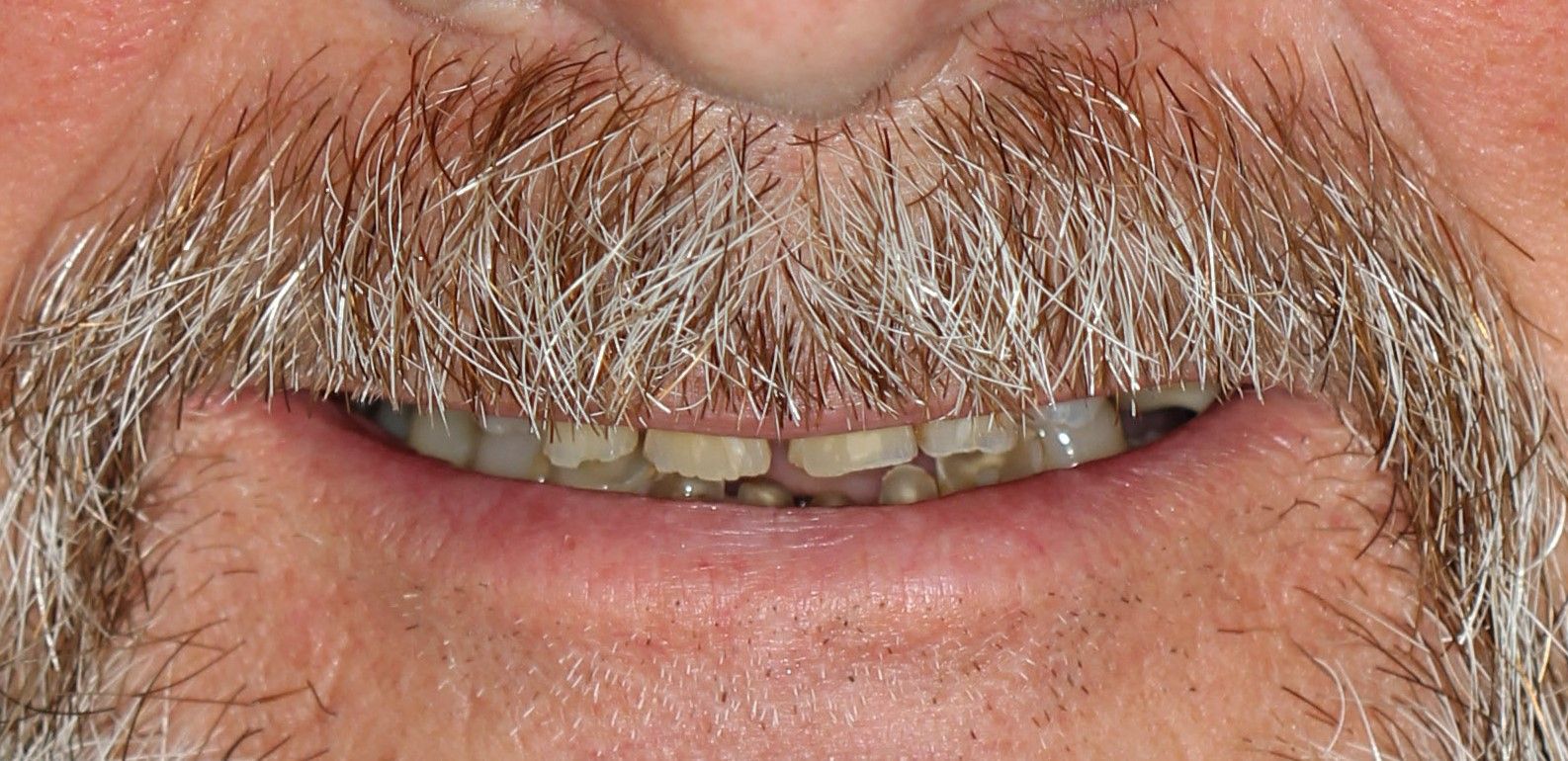 Missing teeth and decay before dental implants