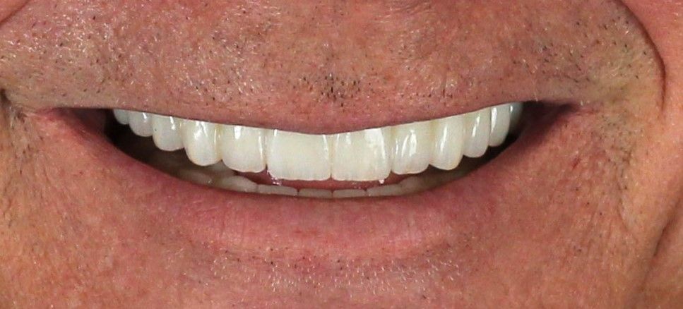 Full arch dental implants after smile restoration
