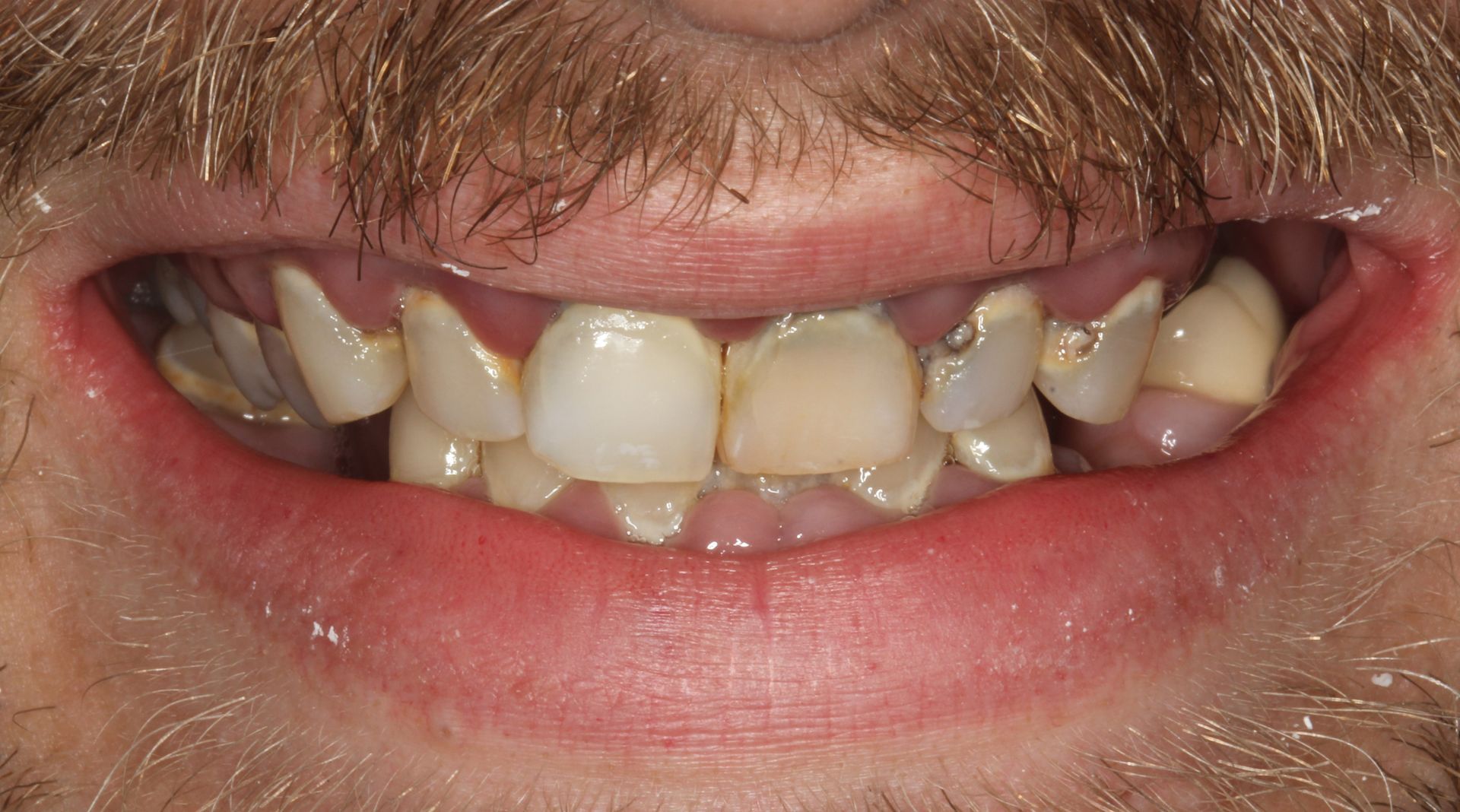 Severely damaged teeth before dental implants