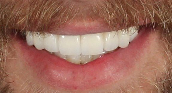 Dental implants after smile transformation