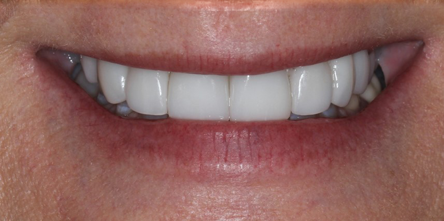 Dental implant after full smile restoration