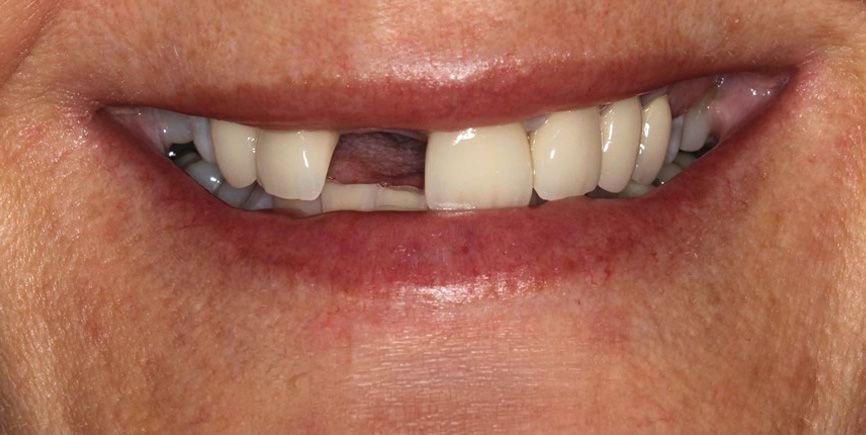 Dental implant before missing teeth smile