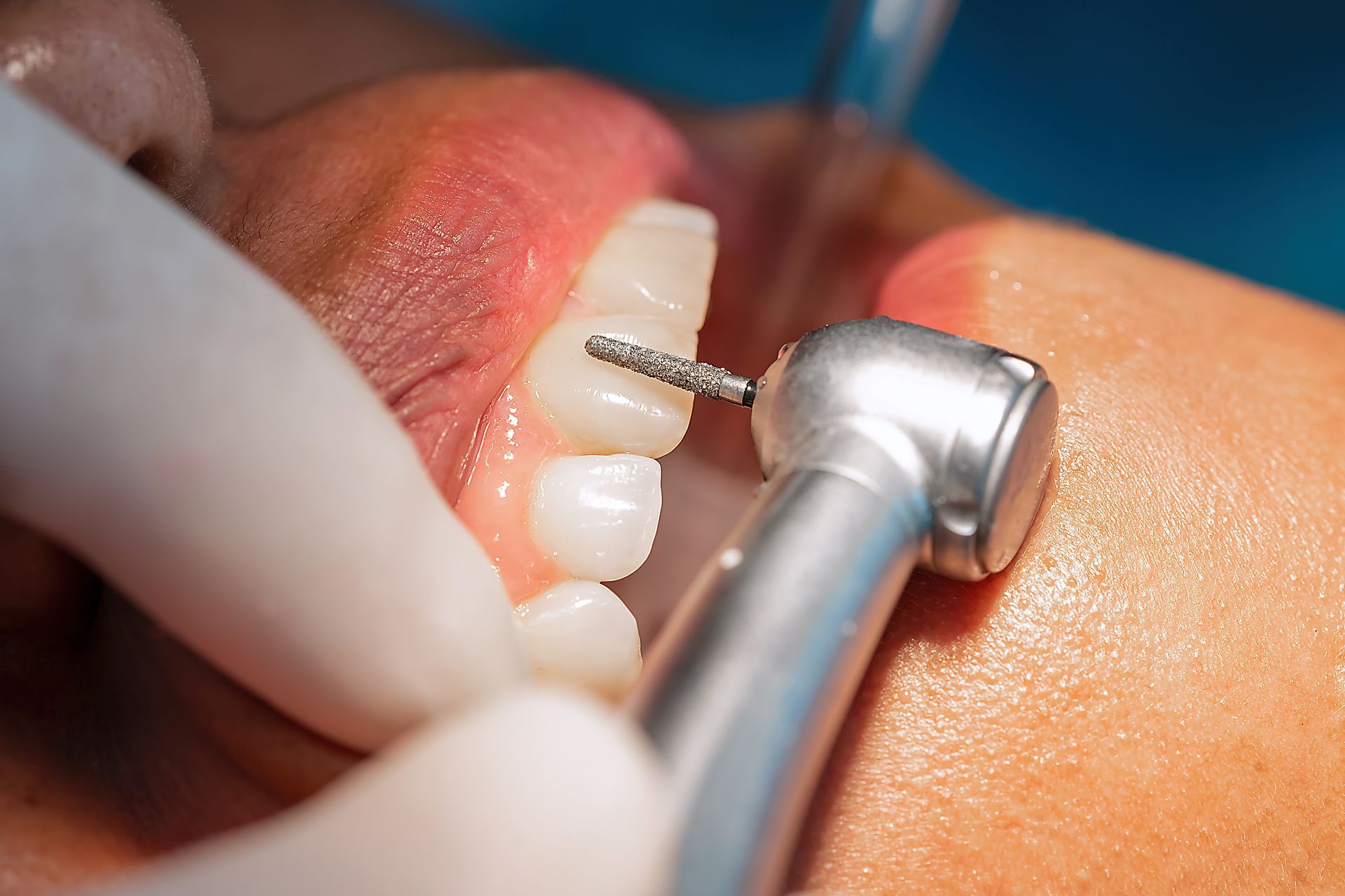 Macro view of a dentist using a rotary drill to prepare the tooth surface for veneer placement.