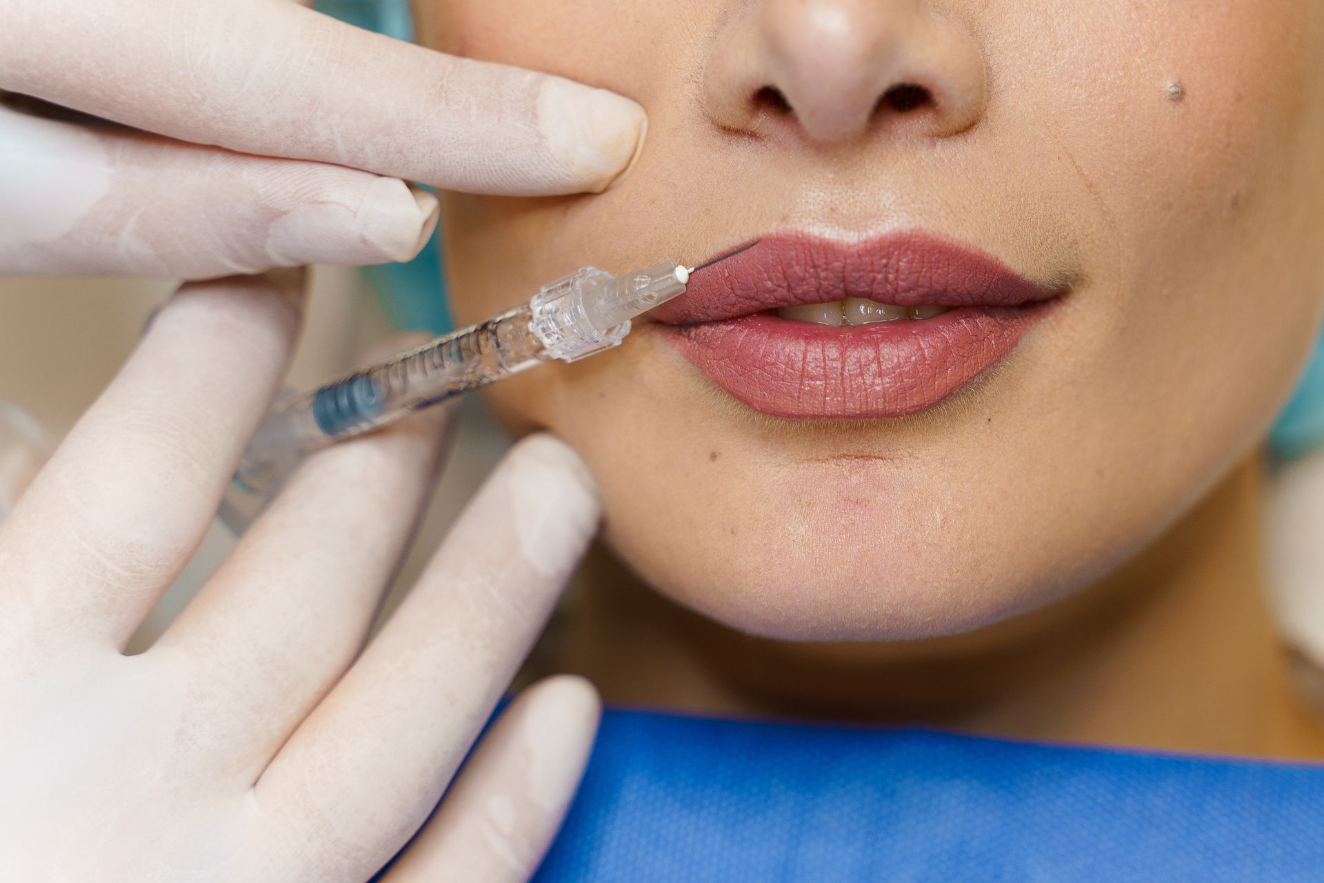 Close-up of syringe injecting dermal filler into a patient's lips.
