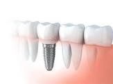 Tooth implant placement near  Garnet Valley, PA