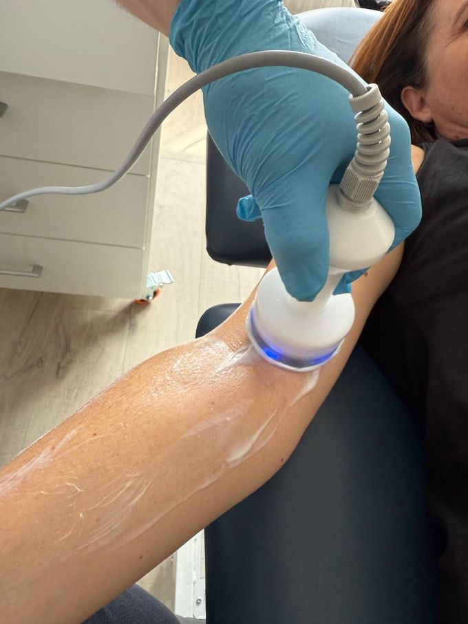 A person's arm being treated with a device emitting blue light, by someone wearing a blue glove.