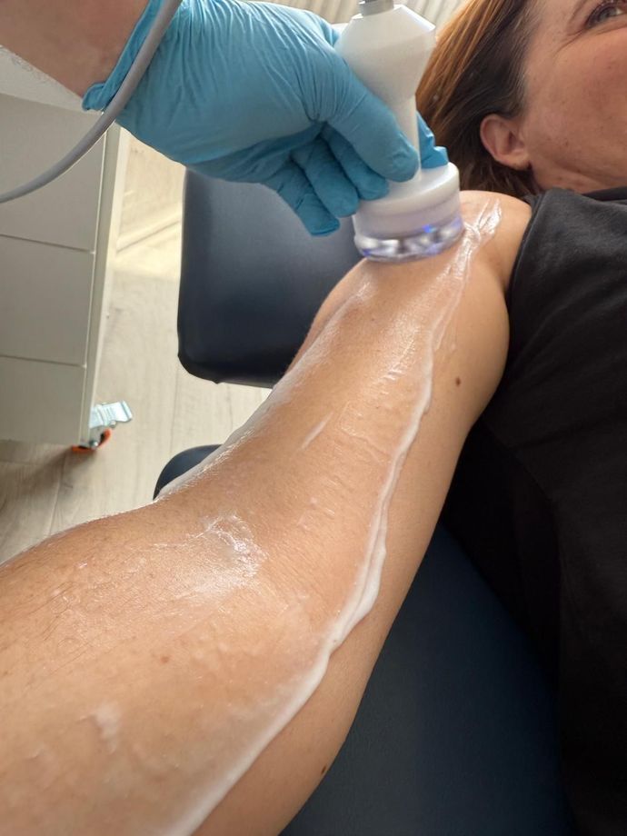 Arm being treated with device, coated in cream. Someone in blue gloves holds the device.