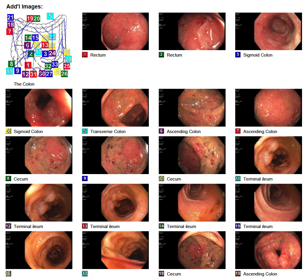 Colonoscopy, GI Cure, Ulcerative Colitis