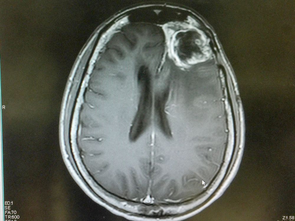 glioblastoma