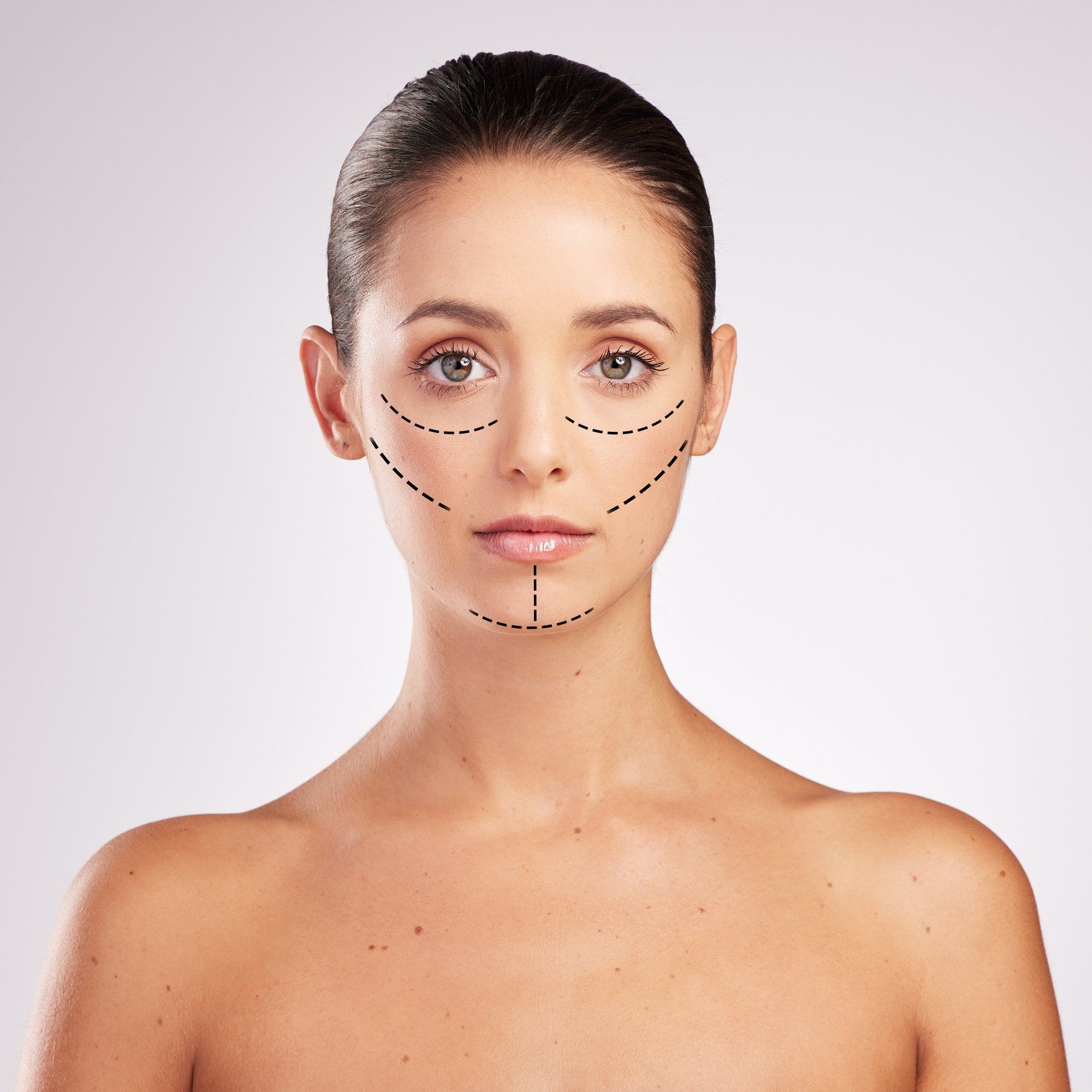 Young Woman With Cosmetic Surgery Markings On Her Face - Chamberlain, SD - Rejuvenating Remedies Med Spa