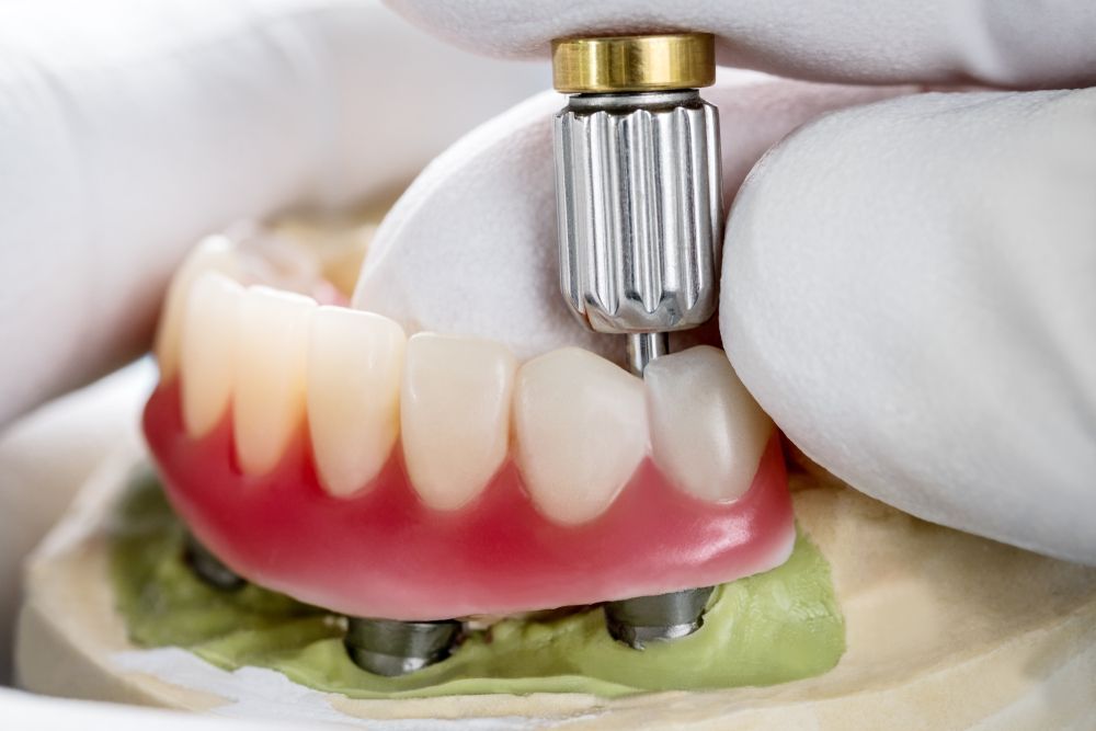 A close up of a person holding a dental implant in their mouth. — Twin Towns Denture Clinic In Tuncurry, NSW