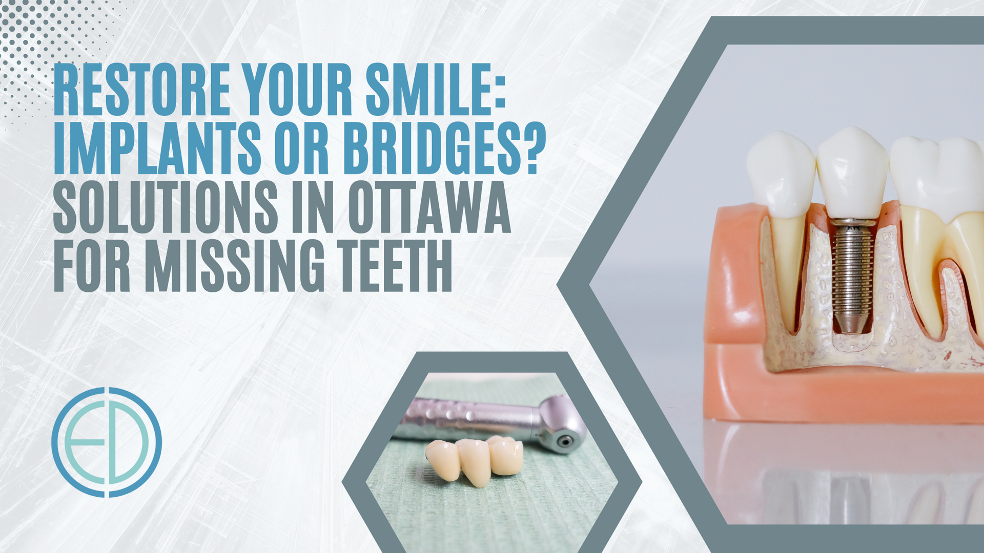 Restore your smile : implants or bridges ? solutions in ottawa for missing teeth