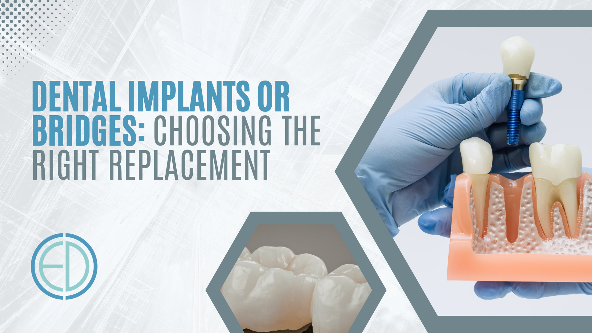 Dental implants or bridges: choosing the right replacement, with dental models and gloved hands