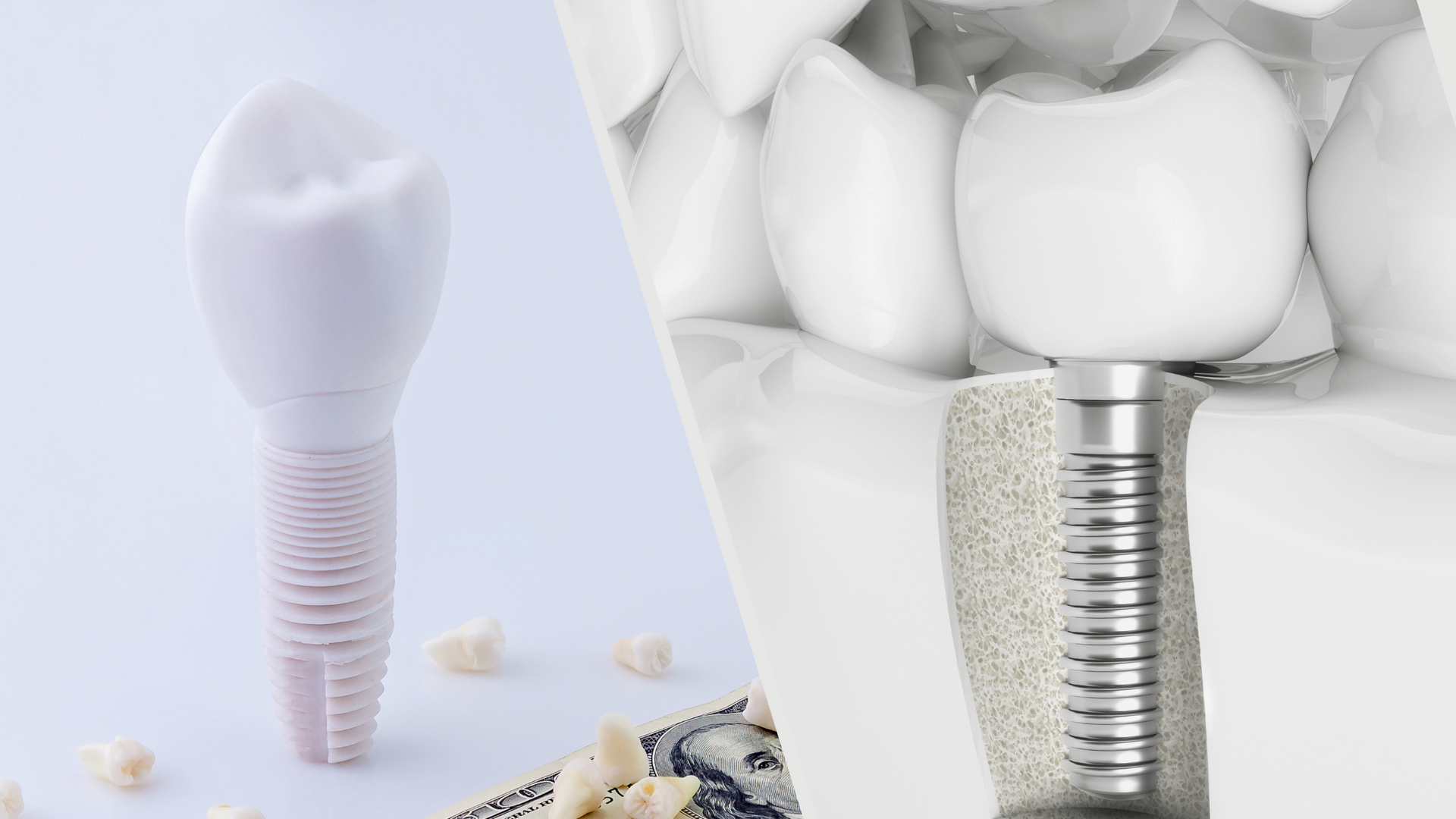 A picture of a dental implant next to a picture of a tooth.