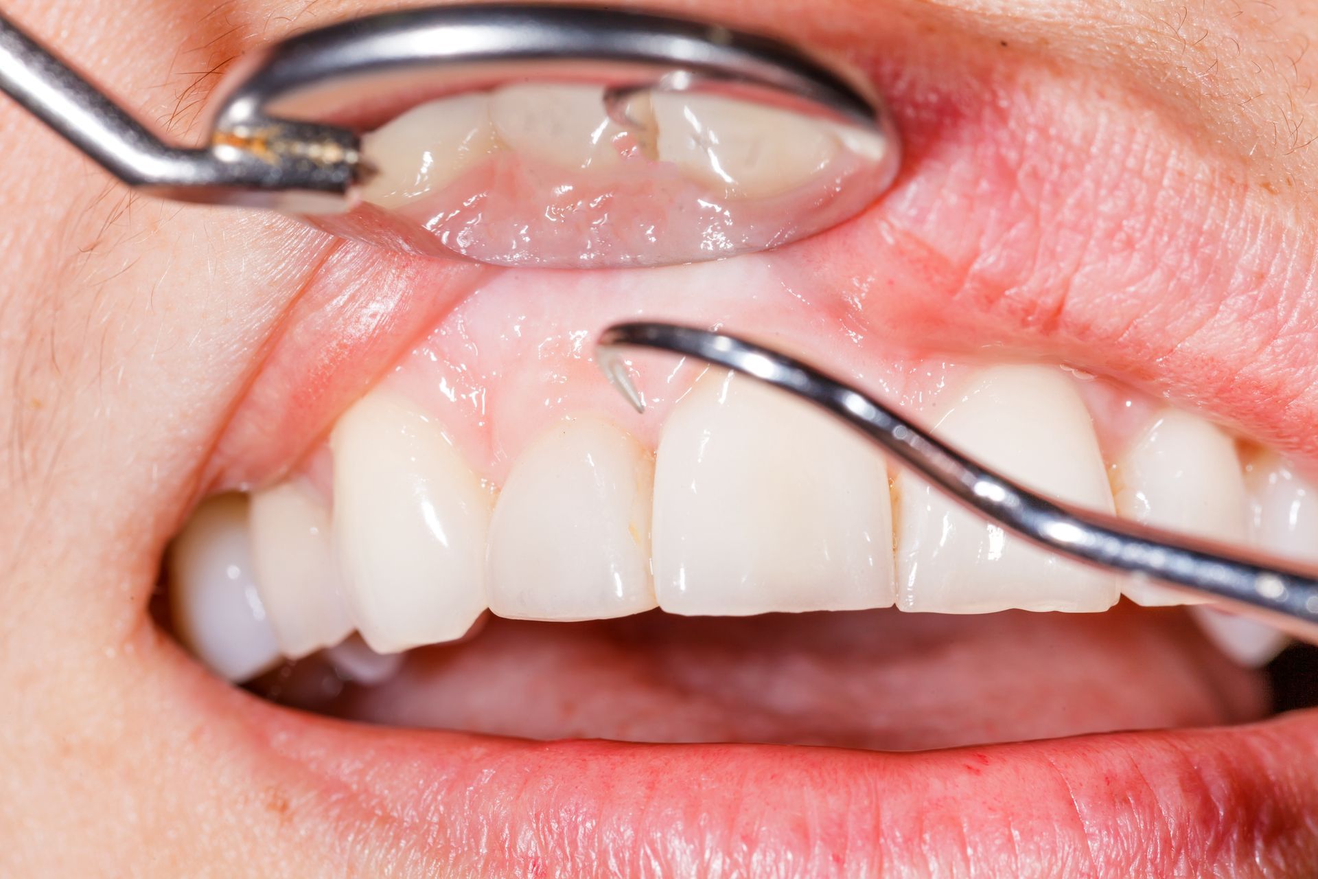Dental examination showing gum recession and probing around teeth to assess gum disease and periodontal health