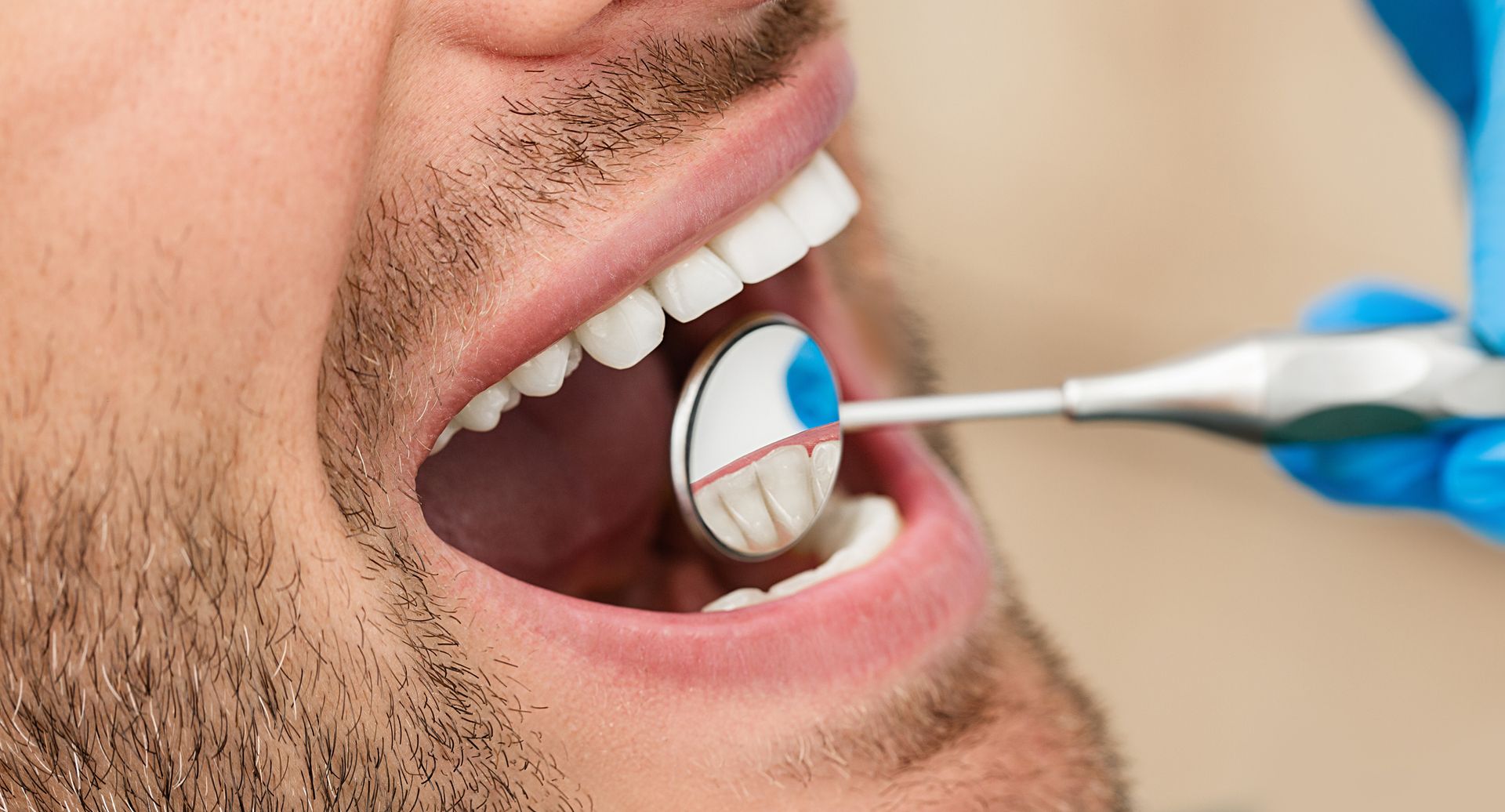 White male smile close-up, dentist’s mirror reflects teeth during treatment.