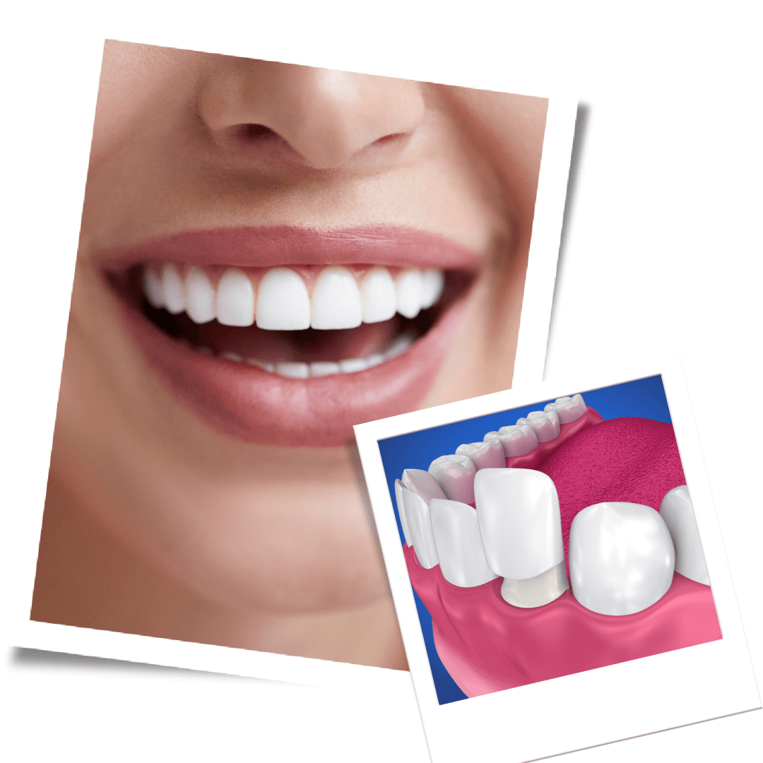 Porcelain Veneers