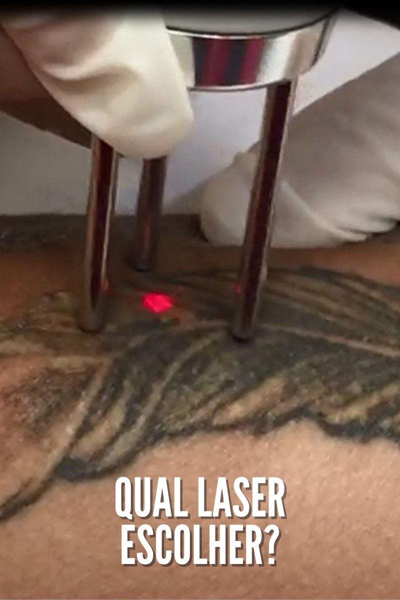 Qual laser escolher para a Remoção de Tatuagens?