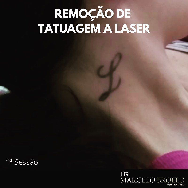 Quantas sessões são necessárias para remover uma tatuagem? Quantas sessões são necessárias para remover uma tatuagem?