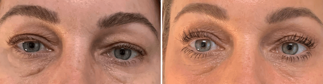 Regenerative Treatment for Under Eye Wrinkles and Bags