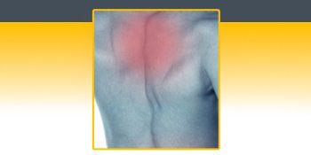 Upper Back Pain — Sarasota, FL — Meilus Precision Therapy