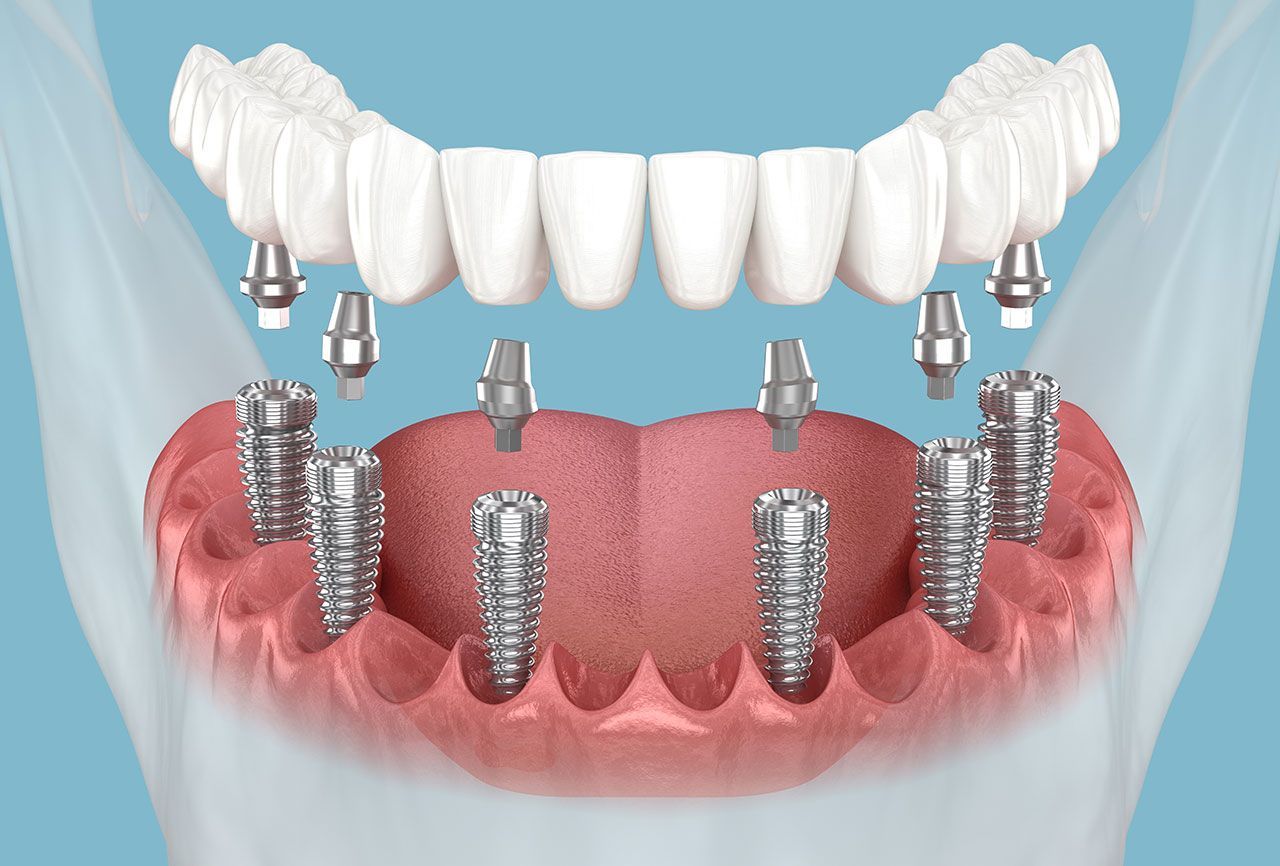 All-On-4® And Full-Arch Dental Implants In Detroit: A Clear Guide To “New Teeth In A Day” Options