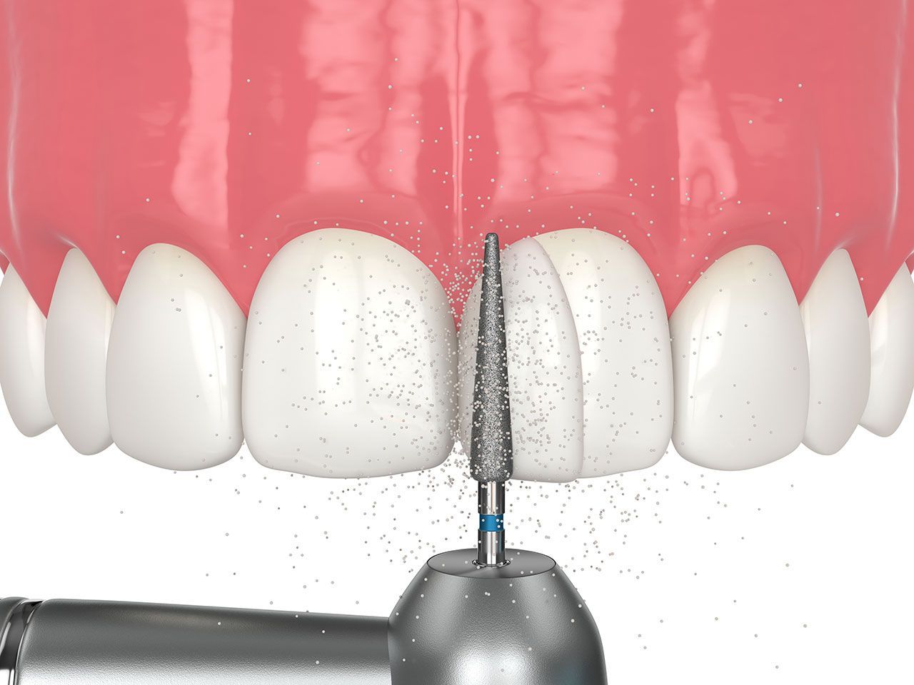 Bonding, Shaping, and Contouring Teeth