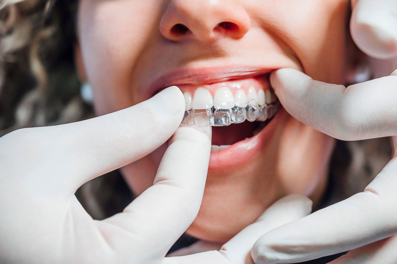 Braces & Clear Aligners In Detroit: A Straightforward Guide For Adults And Teens