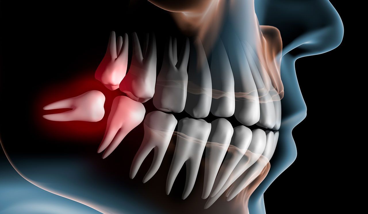 Wisdom Teeth & Extractions In Detroit: When To Watch, When To Remove, And How To Recover Faster