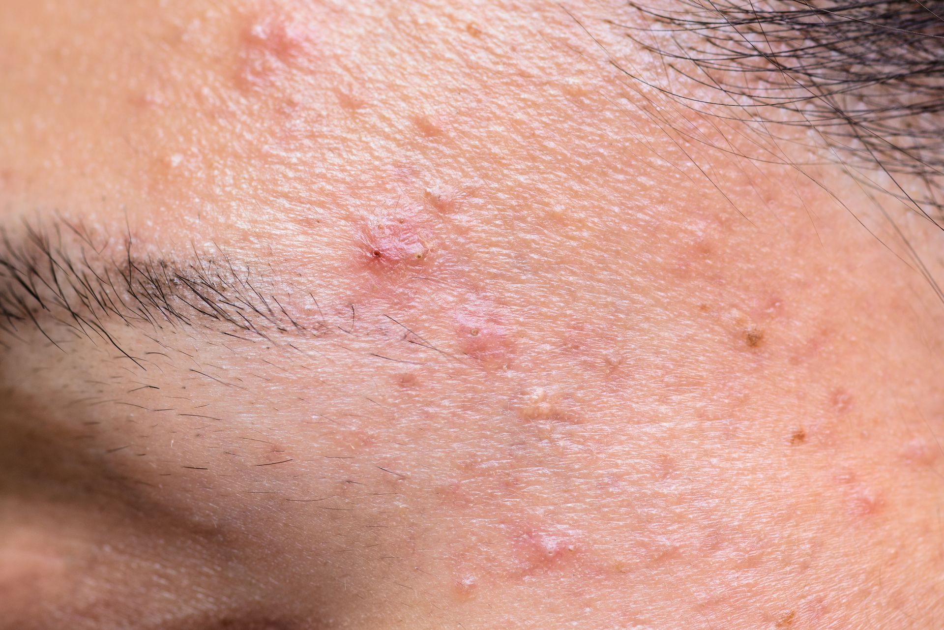 Un gros plan du visage d'une personne avec de l'acné dessus.