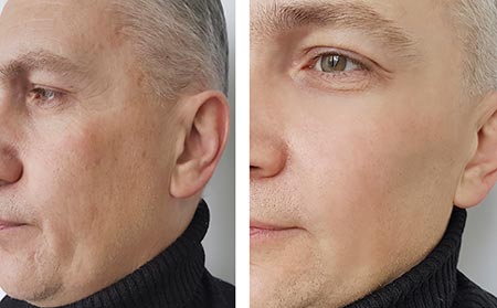 Botox — Man Before And After Botox in Merrillville, IN