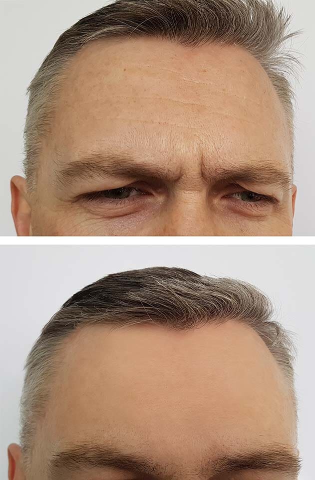 Botox — Male Forehead Before and After in Merrillville, IN