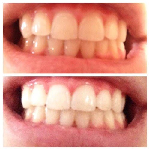 Oral Health — Before And After Teeth Whitening in Merrillville, IN