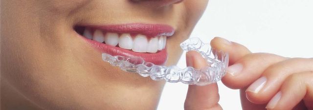 Reasons Why You Should Choose Invisalign Over Braces - West