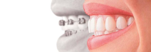 Clear Aligners for Straighter Teeth - ClearCorrect vs. Invisalign