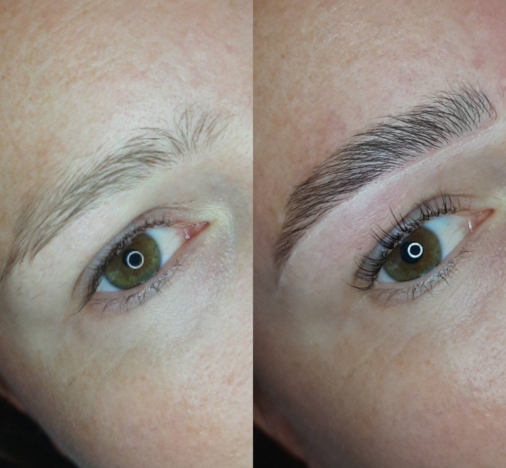 Brow lift