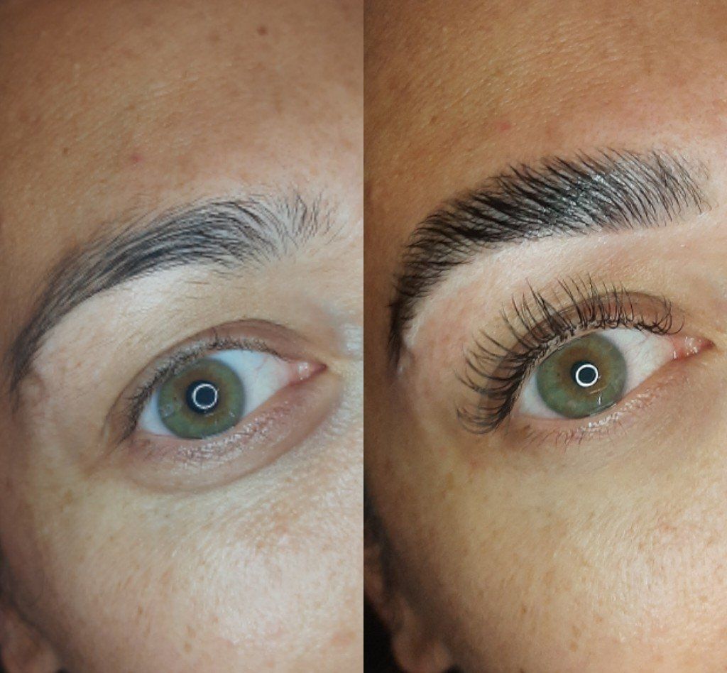 brow lift haarlem