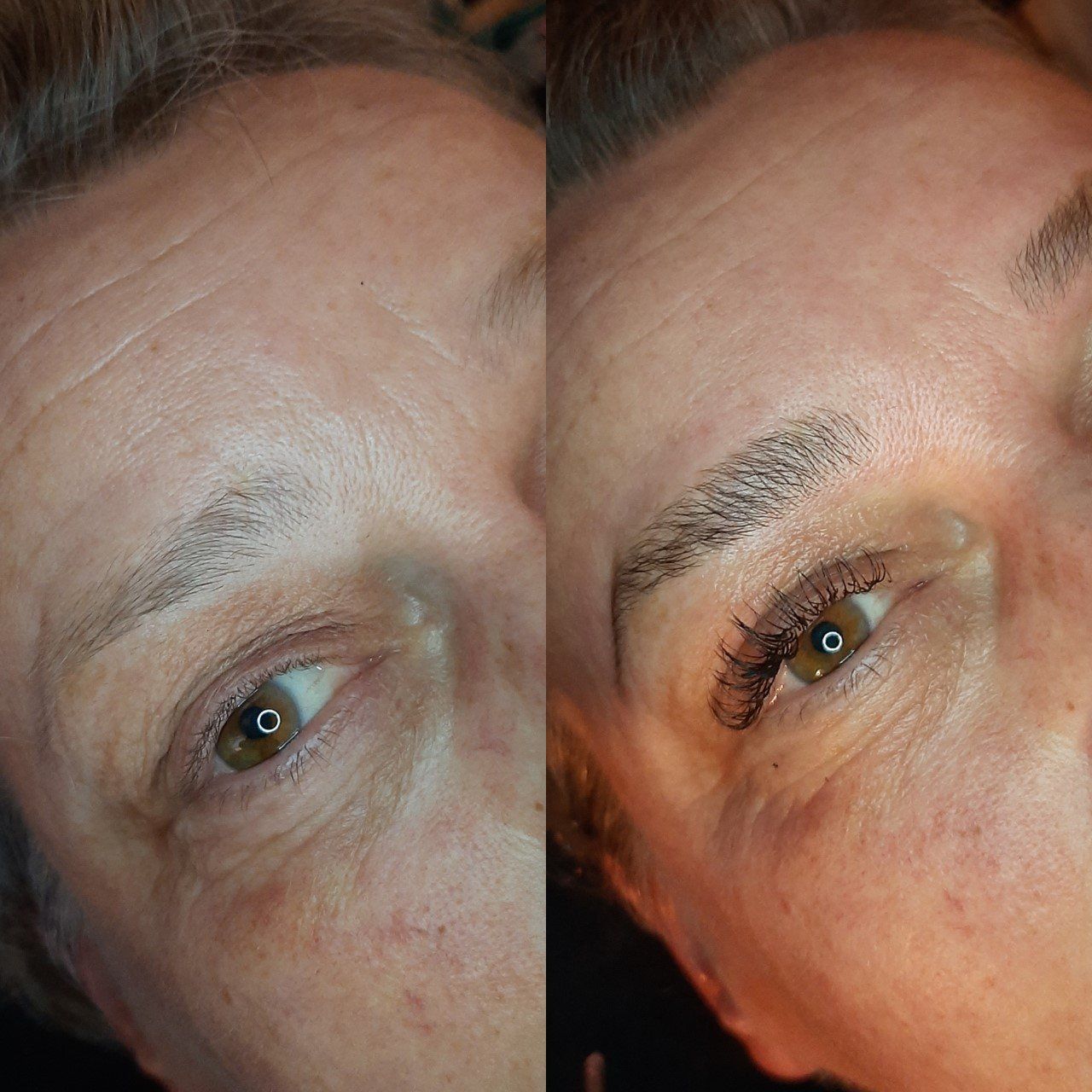 brow lift hoofddorp