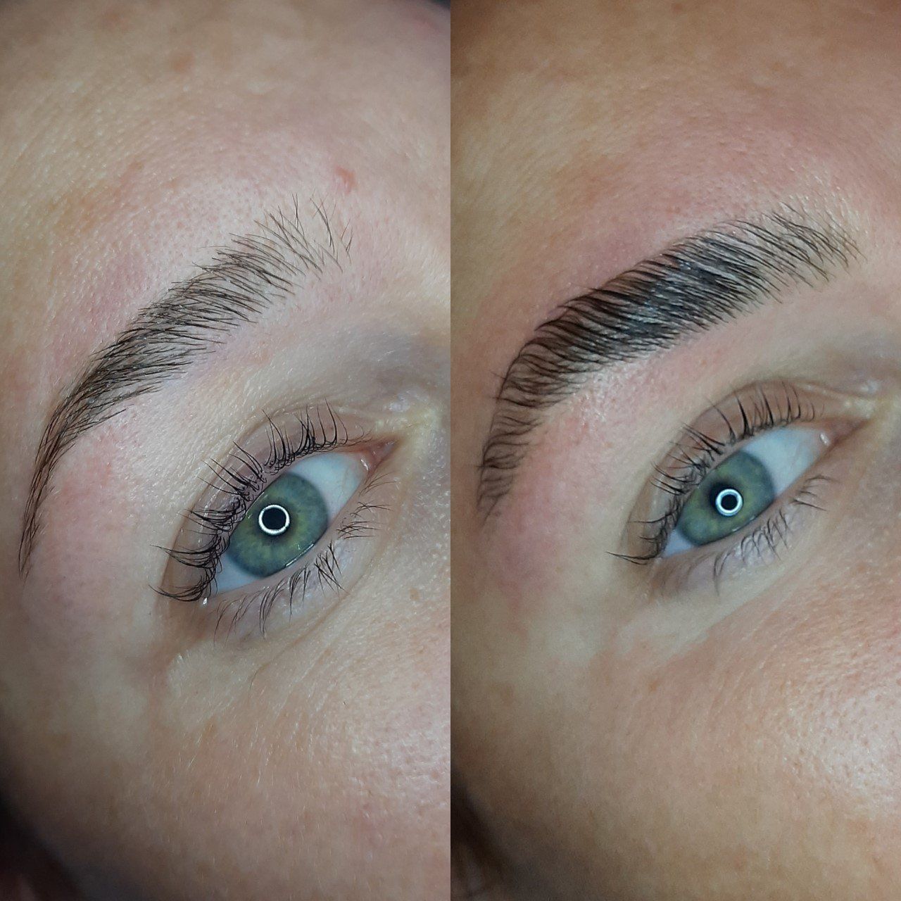brow lift schalkwijk