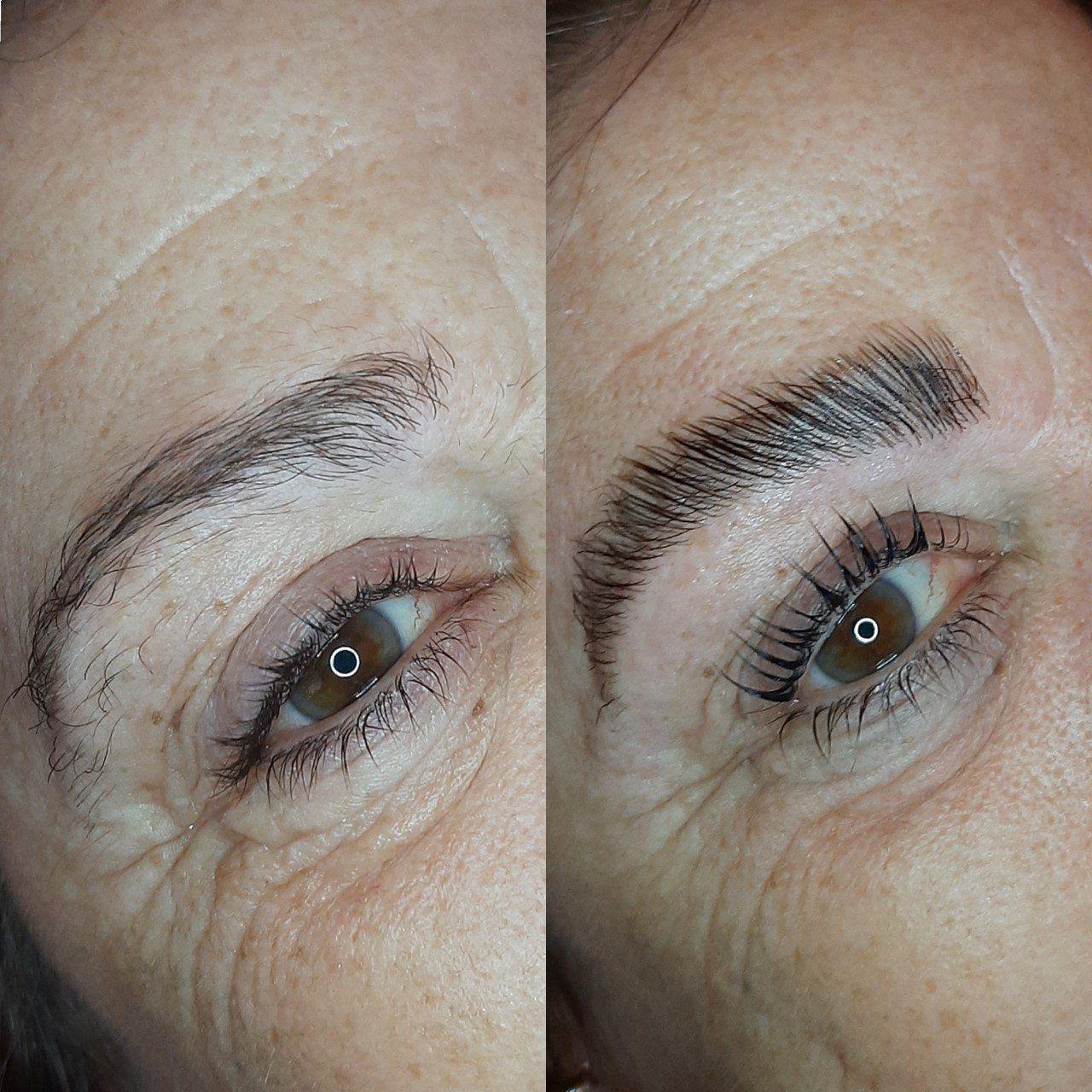 brow lifting haarlem