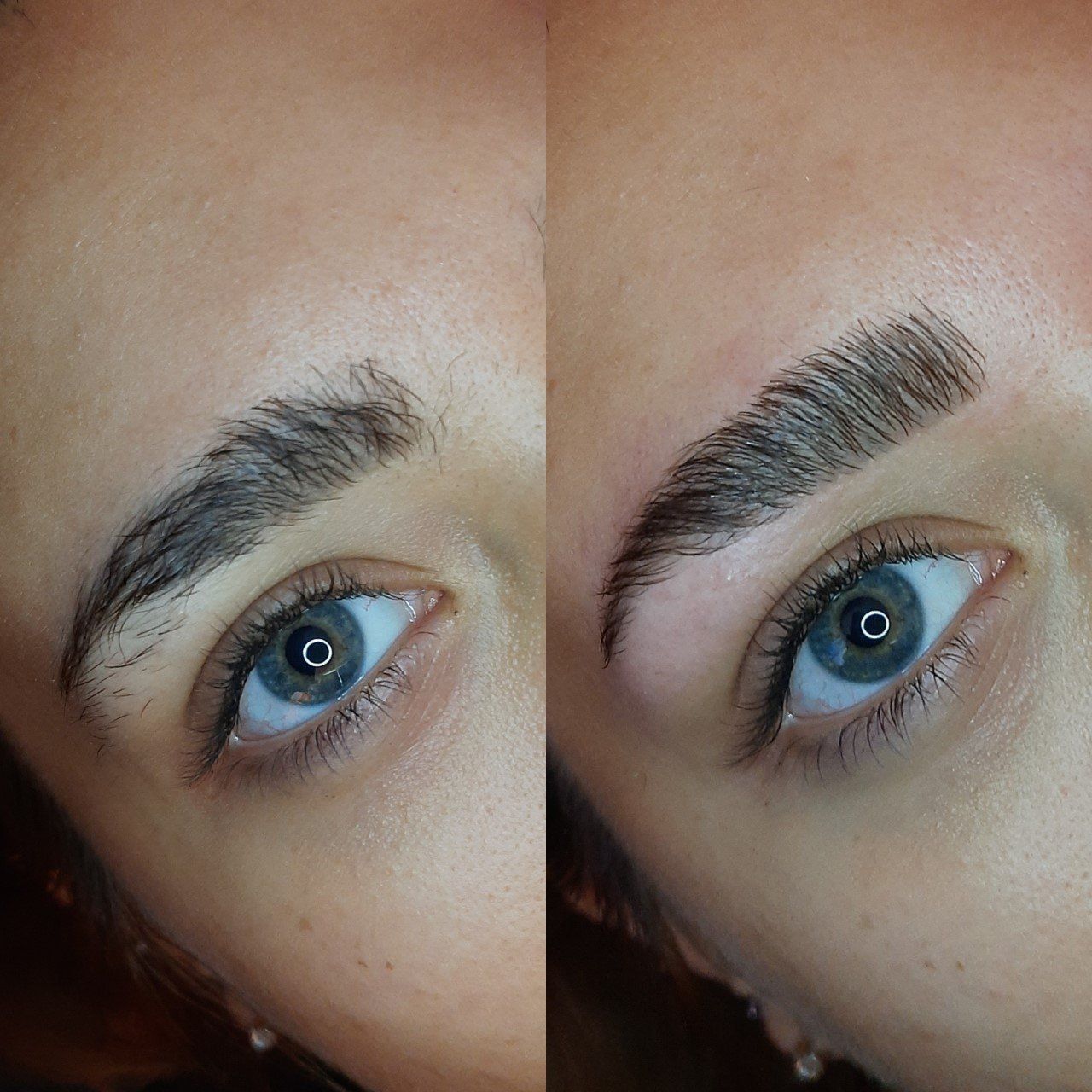 brow lifting hoofddorp